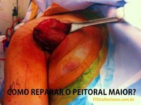 Lesão no Tendão do Peitoral Maior: ainda sem Solução?